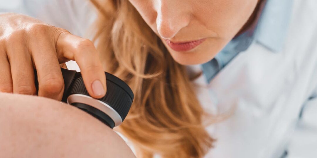 Prevención del cáncer de piel