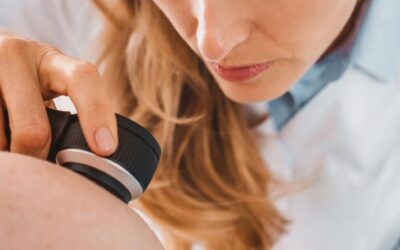 Prevención del cáncer de piel